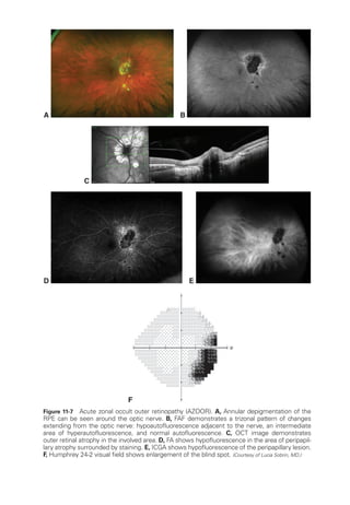 A
C
B
D E
F
Figure 11-7 Acute zonal occult outer retinopathy (AZOOR). A, Annular depigmentation of the
RPE can be seen around the optic nerve. B, FAF demonstrates a trizonal pattern of changes
extending from the optic nerve: hypoautofluorescence adjacent to the nerve, an intermediate
area of hyperautofluorescence, and normal autofluorescence. C, OCT image demonstrates
outer ret­
i­
nal atrophy in the involved area. D, FA shows hypofluorescence in the area of peripapil-
lary atrophy surrounded by staining. E, ICGA shows hypofluorescence of the peripapillary lesion.
F, Humphrey 24-2 visual field shows enlargement of the blind spot. (Courtesy of Lucia Sobrin, MD.)
 