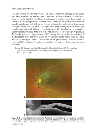 260 ● Retina and Vitreous
Men and ­
women are affected equally. The cause is unknown, although isolated cases
have been associated with coxsackievirus infection. Initially, only central unilateral le-
sions ­
were described, but both bilateral and eccentric macular lesions have since been
added to the disease spectrum. The main clinical finding is an exudative neurosensory
macular detachment with ­
little or no vitreous inflammation and variable discoloration
of the under­
lying RPE (Fig 11-9). Mild optic nerve head swelling, ret­
i­
nal hemorrhages,
vasculitis, and subret­
i­
nal infiltrates occur infrequently. FA typically shows progressive ir-
regular hyperfluorescence at the level of the RPE, followed in the late stages by pooling in
the detachment space. High-­
resolution OCT imaging documents the size and extent of
the detachment space and shows loss of the hyperreflective outer ret­
i­
nal bands associated
with the photoreceptors and RPE. The lesions resolve spontaneously but leave a bull’s-­
eye
pattern of RPE alteration. Typically near-­
complete recovery of vision occurs over weeks
to months.
Freund KB, Yannuzzi LA, Barile GR, Spaide RF, Milewski SA, Guyer DR. The expanding
clinical spectrum of unilateral acute idiopathic maculopathy. Arch Ophthalmol.
1996;114(5):555–559.
Figure 11-9 Acute idiopathic maculopathy. A, Ret­
i­
nal hemorrhages and an exudative neurosen-
sory macular detachment with under­
lying yellowish discoloration. B, OCT through the lesion
shows subret­
i­
nal fluid with hyperreflective debris and loss of the outer ret­
i­
nal bands. (Courtesy of
Lucia Sobrin, MD.)
A
B
 