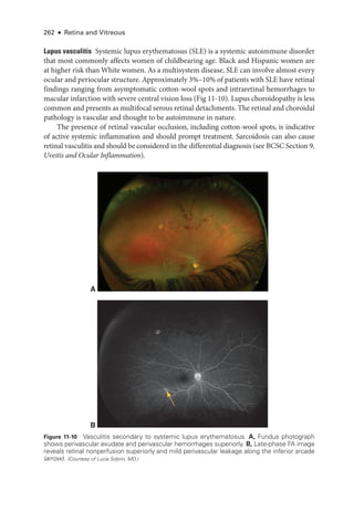 262 ● Retina and Vitreous
Lupus vasculitis Systemic lupus erythematosus (SLE) is a systemic autoimmune disorder
that most commonly affects ­
women of childbearing age. Black and Hispanic ­
women are
at higher risk than White ­
women. As a multisystem disease, SLE can involve almost ­
every
ocular and periocular structure. Approximately 3%–10% of patients with SLE have ret­
i­
nal
findings ranging from asymptomatic cotton-­
wool spots and intraret­
i­
nal hemorrhages to
macular infarction with severe central vision loss (Fig 11-10). Lupus choroidopathy is less
common and pre­sents as multifocal serous ret­
i­nal detachments. The ret­
i­
nal and choroidal
pathology is vascular and thought to be autoimmune in nature.
The presence of ret­
i­
nal vascular occlusion, including cotton-­
wool spots, is indicative
of active systemic inflammation and should prompt treatment. Sarcoidosis can also cause
ret­
i­
nal vasculitis and should be considered in the differential diagnosis (see BCSC Section 9,
Uveitis and Ocular Inflammation).
A
B
Figure 11-10 Vasculitis secondary to systemic lupus erythematosus. A, Fundus photo­
graph
shows perivascular exudate and perivascular hemorrhages superiorly. B, Late-­
phase FA image
reveals ret­
i­
nal nonperfusion superiorly and mild perivascular leakage along the inferior arcade
(arrow). (Courtesy of Lucia Sobrin, MD.)
 