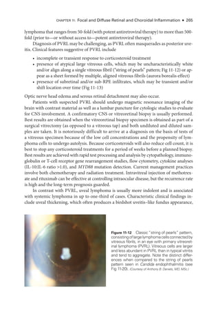 Chapter 11: Focal and Diffuse Ret­
i­
nal and Choroidal Inflammation ● 265
lymphoma that ranges from 50-­fold (with potent antiretroviral therapy) to more than 500-­
fold (prior to—or without access to—­
potent antiretroviral therapy).
Diagnosis of PVRL may be challenging, as PVRL often masquerades as posterior uve-
itis. Clinical features suggestive of PVRL include
• incomplete or transient response to corticosteroid treatment
• presence of aty­
pi­
cal large vitreous cells, which may be uncharacteristically white
and/or align along a single vitreous fibril (“string of pearls” pattern; Fig 11-12) or ap-
pear as a sheet formed by multiple, aligned vitreous fibrils (aurora borealis effect)
• presence of subret­
i­
nal and/or sub-­
RPE infiltrates, which may be transient and/or
shift location over time (Fig 11-13)
Optic nerve head edema and serous ret­
i­
nal detachment may also occur.
Patients with suspected PVRL should undergo magnetic resonance imaging of the
brain with contrast material as well as a lumbar puncture for cytologic studies to evaluate
for CNS involvement. A confirmatory CNS or vitreoret­
i­
nal biopsy is usually performed.
Best results are obtained when the vitreoret­
i­
nal biopsy specimen is obtained as part of a
surgical vitrectomy (as opposed to a vitreous tap) and both undiluted and diluted sam-
ples are taken. It is notoriously difficult to arrive at a diagnosis on the basis of tests of
a vitreous specimen ­
because of the low cell concentrations and the propensity of lym-
phoma cells to undergo autolysis. ­
Because corticosteroids ­
will also reduce cell count, it is
best to stop any corticosteroid treatments for a period of weeks before a planned biopsy.
Best results are achieved with rapid test pro­
cessing and analy­
sis by cytopathology, immuno-
globulin or T-­
cell receptor gene rearrangement studies, flow cytometry, cytokine analyses
(IL-10:IL-6 ratio 1.0), and MYD88 mutation detection. Current management practices
involve both chemotherapy and radiation treatment. Intravitreal injection of methotrex-
ate and rituximab can be effective at controlling intraocular disease, but the recurrence rate
is high and the long-­
term prognosis guarded.
In contrast with PVRL, uveal lymphoma is usually more indolent and is associated
with systemic lymphoma in up to one-­
third of cases. Characteristic clinical findings in-
clude uveal thickening, which often produces a birdshot uveitis–­
like fundus appearance,
Figure 11-12 Classic “string of pearls” pattern,
consistingoflargelymphomacellsconnectedby
vitreous fibrils, in an eye with primary vitreoret­
i­
nal lymphoma (PVRL). Vitreous cells are larger
and less abundant in PVRL than in typical vitritis
and tend to aggregate. Note the distinct differ-
ences when compared to the string of pearls
pattern seen in Candida endophthalmitis (see
Fig 11-20). (Courtesy of Anthony B. Daniels, MD, MSc.)
 
