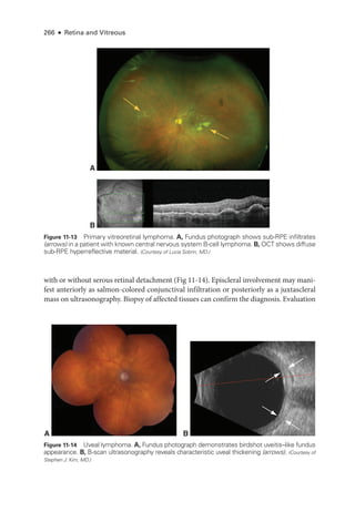 266 ● Retina and Vitreous
with or without serous ret­
i­
nal detachment (Fig 11-14). Episcleral involvement may mani-
fest anteriorly as salmon-­
colored conjunctival infiltration or posteriorly as a juxtascleral
mass on ultrasonography. Biopsy of affected tissues can confirm the diagnosis. Evaluation
A B
Figure 11-14 Uveal lymphoma. A, Fundus photo­
graph demonstrates birdshot uveitis–­
like fundus
appearance. B, B-­
scan ultrasonography reveals characteristic uveal thickening (arrows). (Courtesy of
Stephen J. Kim, MD.)
A
B
Figure 11-13 Primary vitreoret­i­nal lymphoma. A, Fundus photo­
graph shows sub-­
RPE infiltrates
(arrows) in a patient with known central ner­
vous system B-­
cell lymphoma. B, OCT shows diffuse
sub-­
RPE hyperreflective material. (Courtesy of Lucia Sobrin, MD.)
 