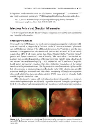 Chapter 11: Focal and Diffuse Ret­
i­
nal and Choroidal Inflammation ● 267
for systemic involvement includes use of computed tomography (CT) or combined CT
and positron emission tomography (PET) imaging of the thorax, abdomen, and pelvis.
Chan CC, Sen HN. Current concepts in diagnosing and managing primary vitreoret­
i­
nal
(intraocular) lymphoma. Discov Med. 2013;15(81):93–100.
Infectious Ret­
i­
nal and Choroidal Inflammation
The following sections briefly describe selected infectious diseases that can cause ret­
i­
nal
and choroidal inflammation.
Cytomegalovirus Retinitis
Cytomegalovirus (CMV) causes the most common infectious congenital syndrome world-
wide and can result in congenital CMV retinitis (see BCSC Section 6, Pediatric Ophthalmol-
ogy and Strabismus, Chapter 27 for additional discussion). CMV retinitis is also the most
common ocular opportunistic infection in adult patients with advanced AIDS and usually
occurs when CD4+
T-­
cell counts are less than 50/µL. Patients with CMV retinitis typically
pre­
sent with floaters or decreased vision. Clinically, CMV retinitis has a characteristic ap-
pearance that consists of opacification of the necrotic ret­
ina, typically along ret­
i­
nal vessels
and often with areas of hemorrhage (Fig 11-15). Periphlebitis and “frosted branch” angiitis—­
florid, dense, perivascular exudation that often obliterates visualization of the ret­
i­
nal
vessels—­
may be prominent features. The degree of vitreous inflammation is highly variable
but often minimal in immunocompromised patients. Early CMV retinitis may resemble
the cotton-­
wool spots associated with HIV-­
related retinopathy. Although the diagnosis is
often made clinically, polymerase chain reaction (PCR)–­
based analy­
sis of ocular fluids
may be diagnostic in unclear cases.
CMV retinitis can be treated with oral valganciclovir, or with ganciclovir or foscarnet,
administered systemically or intravitreally. High-­
dose induction therapy is typically given
for 2–3 weeks, ­after which maintenance therapy is continued ­until immune reconstitution
A B
Figure 11-15 Cytomegalovirus retinitis. A, Retinitis with a hemorrhagic component in a patient
with AIDS. B, Granular appearance of retinitis in a patient ­
after renal transplant. (Courtesy of Lucia
Sobrin, MD.)
 