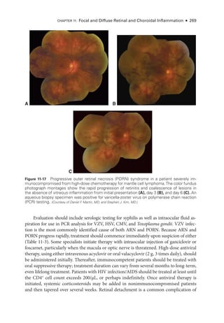 Chapter 11: Focal and Diffuse Ret­
i­
nal and Choroidal Inflammation ● 269
Evaluation should include serologic testing for syphilis as well as intraocular fluid as-
piration for use in PCR analy­
sis for VZV, HSV, CMV, and Toxoplasma gondii. VZV infec-
tion is the most commonly identified cause of both ARN and PORN. ­
Because ARN and
PORN pro­
gress rapidly, treatment should commence immediately upon suspicion of ­
either
(­Table 11-3). Some specialists initiate therapy with intraocular injection of ganciclovir or
foscarnet, particularly when the macula or optic nerve is threatened. High-­
dose antiviral
therapy, using ­
either intravenous acyclovir or oral valacyclovir (2 g, 3 times daily), should
be administered initially. Thereafter, immunocompetent patients should be treated with
oral suppressive therapy; treatment duration can vary from several months to long-­
term,
even lifelong treatment. Patients with HIV infection/AIDS should be treated at least ­
until
the CD4+
cell count exceeds 200/µL, or perhaps in­
def­
initely. Once antiviral therapy is
initiated, systemic corticosteroids may be added in nonimmunocompromised patients
and then tapered over several weeks. Ret­
i­
nal detachment is a common complication of
A B
C
Figure 11-17 Progressive outer ret­
i­
nal necrosis (PORN) syndrome in a patient severely im-
munocompromised from high-­
dose chemotherapy for mantle cell lymphoma.The color fundus
photo­
graph montages show the rapid progression of retinitis and coalescence of lesions in
the absence of vitreous inflammation from initial pre­
sen­
ta­
tion (A), day 3 (B), and day 6 (C). An
aqueous biopsy specimen was positive for varicella-­
zoster virus on polymerase chain reaction
(PCR) testing. (Courtesy of Daniel F
. Martin, MD, and Stephen J. Kim, MD.)
 