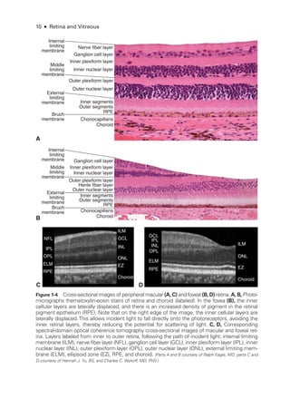 10 ● Retina and Vitreous
NFL
ILM
GCL
ILM
ONL
EZ
Choroid
IPL
INL
OPL
ELM
RPE
GCL
INL
ONL
EZ
Choroid
IPL
OPL
ELM
RPE
Choroid
Choriocapillaris
Outer segments
RPE
Outer nuclear layer
Inner nuclear layer
Inner plexiform layer
Ganglion cell layer
Nerve fiber layer
Outer plexiform layer
Inner segments
Bruch
membrane
A
External
limiting
membrane
Internal
limiting
membrane
Middle
limiting
membrane
C
Outer nuclear layer
Henle fiber layer
Inner nuclear layer
Inner plexiform layer
Ganglion cell layer
Outer plexiform layer
Inner segments
B Choroid
Choriocapillaris
Outer segments
RPE
Bruch
membrane
External
limiting
membrane
Internal
limiting
membrane
Middle
limiting
membrane
D
Figure 1-4 Cross-­
sectional images of peripheral macular (A, C) and foveal (B, D) ret­ina. A, B, Photo­
micrographs (hematoxylin-­
eosin stain) of ret­
ina and choroid (labeled). In the fovea (B), the inner
cellular layers are laterally displaced, and ­
there is an increased density of pigment in the ret­
i­
nal
pigment epithelium (RPE). Note that on the right edge of the image, the inner cellular layers are
laterally displaced. This allows incident light to fall directly onto the photoreceptors, avoiding the
inner ret­
i­
nal layers, thereby reducing the potential for scattering of light. C, D, Corresponding
spectral-domain optical coherence tomography cross-­
sectional images of macular and foveal ret­
ina. Layers labeled from inner to outer ret­
ina, following the path of incident light: internal limiting
membrane (ILM), nerve fiber layer (NFL), ganglion cell layer (GCL), inner plexiform layer (IPL), inner
nuclear layer (INL), outer plexiform layer (OPL), outer nuclear layer (ONL), external limiting mem-
brane (ELM), ellipsoid zone (EZ), RPE, and choroid. (Parts A and B courtesy of Ralph Ea­
gle, MD; parts C and
D courtesy of Hannah J. Yu, BS, and Charles C. Wykoff, MD, PhD.)
 