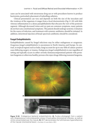 Chapter 11: Focal and Diffuse Ret­
i­
nal and Choroidal Inflammation ● 271
cases can be associated with intravenous drug use or with procedures known to produce
bacteremia, particularly placement of indwelling catheters.
Clinical pre­
sen­
ta­
tion can vary and depends on both the size of the inoculum and
the virulence of the organism; it ranges from a focal chorioretinitis (Fig 11-18) with ­
little
vitreous inflammation to a dense panophthalmitis that obscures the view of the posterior
segment. Although decreased vision and eye pain are common symptoms, many patients
do not have any constitutional symptoms. The patient should undergo systemic evaluation
for the source of infection, and treatment with systemic antibiotics should be initiated. In
addition, intravitreal injection of broad-­
spectrum antibiotics should be considered.
Fungal Endophthalmitis
Endophthalmitis caused by fungal infections may be ­
either endogenous or exogenous.
Exogenous fungal endophthalmitis is uncommon in North Amer­
i­
ca and Eu­
rope. In con-
trast, in tropical regions such as India, fungi account for up to one-­fifth of culture-­positive
cases following surgery or trauma. Endogenous fungal endophthalmitis is rare regardless of
setting and typically occurs in ­
either severely immunocompromised patients with per­
sis­
tent fungemia or other­wise healthy persons who inject drugs following transient fungemia.
A
B
Figure 11-18 Endogenous bacterial endophthalmitis. A, Fundus photo­
graph from a patient
with Streptococcus mitis endocarditis shows 3 focal yellow chorioret­
i­
nal infiltrates, as well as
vitritis concentrated over the macula. B, OCT demonstrates the full-­
thickness hyperreflectivity
of the macular chorioret­
i­
nal lesion. (Courtesy of Lucia Sobrin, MD.)
 
