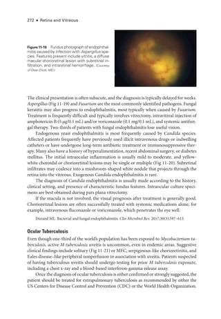 272 ● Retina and Vitreous
The clinical pre­
sen­
ta­
tion is often subacute, and the diagnosis is typically delayed for weeks.
Aspergillus (Fig 11-19) and Fusarium are the most commonly identified pathogens. Fungal
keratitis may also pro­
gress to endophthalmitis, most typically when caused by Fusarium.
Treatment is frequently difficult and typically involves vitrectomy, intravitreal injection of
amphotericin B (5 µg/0.1 mL) and/or voriconazole (0.1 mg/0.1 mL), and systemic antifun-
gal therapy. Two-­
thirds of patients with fungal endophthalmitis lose useful vision.
Endogenous yeast endophthalmitis is most frequently caused by Candida species.
Affected patients frequently have previously used illicit intravenous drugs or indwelling
catheters or have under­
gone long-­
term antibiotic treatment or immunosuppressive ther-
apy. Many also have a history of hyperalimentation, recent abdominal surgery, or diabetes
mellitus. The initial intraocular inflammation is usually mild to moderate, and yellow-­
white choroidal or chorioret­
i­
nal lesions may be single or multiple (Fig 11-20). Subret­i­nal
infiltrates may coalesce into a mushroom-­
shaped white nodule that proj­
ects through the
ret­
ina into the vitreous. Exogenous Candida endophthalmitis is rare.
The diagnosis of Candida endophthalmitis is usually made according to the history,
clinical setting, and presence of characteristic fundus features. Intraocular culture speci-
mens are best obtained during pars plana vitrectomy.
If the macula is not involved, the visual prognosis ­
after treatment is generally good.
Chorioret­
i­
nal lesions are often successfully treated with systemic medi­
cations alone, for
example, intravenous fluconazole or voriconazole, which penetrates the eye well.
Durand ML. Bacterial and fungal endophthalmitis. Clin Microbiol Rev. 2017;30(3):597–613.
Ocular Tuberculosis
Even though one-­
third of the world’s population has been exposed to Mycobacterium tu-
berculosis, active M tuberculosis uveitis is uncommon, even in endemic areas. Suggestive
clinical findings include solitary (Fig 11-21) or MFC, serpiginous-­
like chorioretinitis, and
Eales disease–­
like peripheral nonperfusion in association with uveitis. Patients suspected
of having tuberculous uveitis should undergo testing for prior M tuberculosis exposure,
including a chest x-­
ray and a blood-­
based interferon-­
gamma release assay.
Once the diagnosis of ocular tuberculosis is ­
either confirmed or strongly suggested, the
patient should be treated for extrapulmonary tuberculosis as recommended by ­
either the
US Centers for Disease Control and Prevention (CDC) or the World Health Organ­
ization.
Figure11-19 Fundusphoto­graphofendophthal­
mitis caused by infection with Aspergillus spe-
cies. Features pre­
sent include vitritis, a diffuse
macular chorioret­
i­
nal lesion with subretinal in-
filtration, and intraret­
i­
nal hemorrhage. (Courtesy
of Dean Eliott, MD.)
 