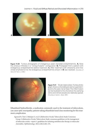 Chapter 11: Focal and Diffuse Ret­
i­
nal and Choroidal Inflammation ● 273
C
B
A
Figure 11-20 Fundus photo­
graphs of endogenous yeast (Candida) endophthalmitis. A, Note
the vitreous infiltrates in a “string of pearls” configuration. B, Photo­
graph from a patient with
endogenous endophthalmitis before treatment. C, ­
After treatment with vitrectomy and intra-
vitreal amphotericin B, the endogenous endophthalmitis shown in B was resolved. (Courtesy of
Harry W. Flynn, Jr, MD.)
Ethambutol hydrochloride, a medi­
cation commonly used in the treatment of tuberculosis,
can cause optic neuropathy; patients taking ethambutol need close monitoring for this treat-
ment complication.
Agrawal R, Testi I, Mahajan S, et al; Collaborative Ocular Tuberculosis Study Consensus
Group. Collaborative Ocular Tuberculosis Study consensus guidelines on the management
of tubercular uveitis—­
report 1: guidelines for initiating antitubercular therapy in tubercular
choroiditis. Ophthalmology. 2021;128(2):266–276.
Figure 11-21 Ocular tuberculosis. Fundus photo­
graph shows a choroidal granuloma superotem-
poral to the optic nerve head.The inflammation
can be localized to the choroid as the overlying
ret­
ina and ret­
i­
nal vessels are relatively spared.
(Courtesy of Janet L. Davis, MD.)
 
