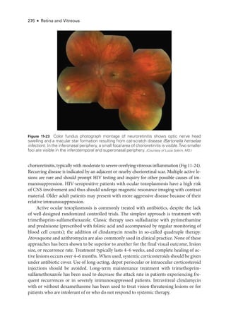 276 ● Retina and Vitreous
chorioretinitis, typically with moderate to severe overlying vitreous inflammation (Fig 11-24).
Recurring disease is indicated by an adjacent or nearby chorioret­
i­
nal scar. Multiple active le-
sions are rare and should prompt HIV testing and inquiry for other pos­
si­
ble ­
causes of im-
munosuppression. HIV-­
seropositive patients with ocular toxoplasmosis have a high risk
of CNS involvement and thus should undergo magnetic resonance imaging with contrast
material. Older adult patients may pre­
sent with more aggressive disease ­
because of their
relative immunosuppression.
Active ocular toxoplasmosis is commonly treated with antibiotics, despite the lack
of well-­
designed randomized controlled ­
trials. The simplest approach is treatment with
trimethoprim-­
sulfamethoxazole. Classic therapy uses sulfadiazine with pyrimethamine
and prednisone (prescribed with folinic acid and accompanied by regular monitoring of
blood cell counts); the addition of clindamycin results in so-­
called qua­
dru­
ple therapy.
Atovaquone and azithromycin are also commonly used in clinical practice. None of ­
these
approaches has been shown to be superior to another for the final visual outcome, lesion
size, or recurrence rate. Treatment typically lasts 4–6 weeks, and complete healing of ac-
tive lesions occurs over 4–6 months. When used, systemic corticosteroids should be given
­
under antibiotic cover. Use of long-­
acting, depot periocular or intraocular corticosteroid
injections should be avoided. Long-­
term maintenance treatment with trimethoprim-­
sulfamethoxazole has been used to decrease the attack rate in patients experiencing fre-
quent recurrences or in severely immunosuppressed patients. Intravitreal clindamycin
with or without dexamethasone has been used to treat vision-­
threatening lesions or for
patients who are intolerant of or who do not respond to systemic therapy.
Figure 11-23 Color fundus photo­
graph montage of neuroretinitis shows optic nerve head
swelling and a macular star formation resulting from cat-­
scratch disease (Bartonella henselae
infection). In the inferonasal periphery, a small focal area of chorioretinitis is vis­
i­
ble.Two smaller
foci are vis­
i­
ble in the inferotemporal and superonasal periphery. (Courtesy of Lucia Sobrin, MD.)
 