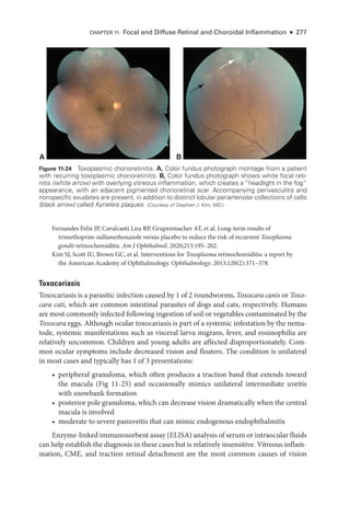 Chapter 11: Focal and Diffuse Ret­
i­
nal and Choroidal Inflammation ● 277
Fernandes Felix JP, Cavalcanti Lira RP, Grupenmacher AT, et al. Long-­
term results of
trimethoprim-sulfamethoxazole versus placebo to reduce the risk of recurrent Toxoplasma
gondii retinochoroiditis. Am J Ophthalmol. 2020;213:195–202.
Kim SJ, Scott IU, Brown GC, et al. Interventions for Toxoplasma retinochoroiditis: a report by
the American Acad­
emy of Ophthalmology. Ophthalmology. 2013;120(2):371–378.
Toxocariasis
Toxocariasis is a parasitic infection caused by 1 of 2 roundworms, Toxocara canis or Toxo-
cara cati, which are common intestinal parasites of dogs and cats, respectively. ­
Humans
are most commonly infected following ingestion of soil or vegetables contaminated by the
Toxocara eggs. Although ocular toxocariasis is part of a systemic infestation by the nema-
tode, systemic manifestations such as visceral larva migrans, fever, and eosinophilia are
relatively uncommon. ­
Children and young adults are affected disproportionately. Com-
mon ocular symptoms include decreased vision and floaters. The condition is unilateral
in most cases and typically has 1 of 3 pre­
sen­
ta­
tions:
• peripheral granuloma, which often produces a traction band that extends ­
toward
the macula (Fig 11-25) and occasionally mimics unilateral intermediate uveitis
with snowbank formation
• posterior pole granuloma, which can decrease vision dramatically when the central
macula is involved
• moderate to severe panuveitis that can mimic endogenous endophthalmitis
Enzyme-­linked immunosorbent assay (ELISA) analy­sis of serum or intraocular fluids
can help establish the diagnosis in ­these cases but is relatively insensitive. Vitreous inflam-
mation, CME, and traction ret­
i­
nal detachment are the most common ­
causes of vision
A B
Figure 11-24 Toxoplasmic chorioretinitis. A, Color fundus photo­
graph montage from a patient
with recurring toxoplasmic chorioretinitis. B, Color fundus photo­
graph shows white focal reti-
nitis (white arrow) with overlying vitreous inflammation, which creates a “headlight in the fog”
appearance, with an adjacent pigmented chorioret­
i­
nal scar. Accompanying perivasculitis and
nonspecific exudates are pre­
sent, in addition to distinct lobular periarteriolar collections of cells
(black arrow) called Kyrieleis plaques. (Courtesy of Stephen J. Kim, MD.)
 