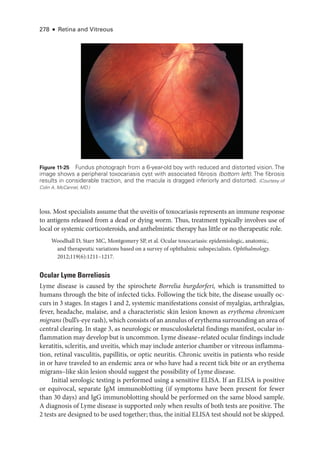 278 ● Retina and Vitreous
loss. Most specialists assume that the uveitis of toxocariasis represents an immune response
to antigens released from a dead or ­
dying worm. Thus, treatment typically involves use of
local or systemic corticosteroids, and anthelmintic therapy has ­
little or no therapeutic role.
Woodhall D, Starr MC, Montgomery SP, et al. Ocular toxocariasis: epidemiologic, anatomic,
and therapeutic variations based on a survey of ophthalmic subspecialists. Ophthalmology.
2012;119(6):1211–1217.
Ocular Lyme Borreliosis
Lyme disease is caused by the spirochete Borrelia burgdorferi, which is transmitted to
­
humans through the bite of infected ticks. Following the tick bite, the disease usually oc-
curs in 3 stages. In stages 1 and 2, systemic manifestations consist of myalgias, arthralgias,
fever, headache, malaise, and a characteristic skin lesion known as erythema chronicum
migrans (bull’s-­eye rash), which consists of an annulus of erythema surrounding an area of
central clearing. In stage 3, as neurologic or musculoskeletal findings manifest, ocular in-
flammation may develop but is uncommon. Lyme disease–­
related ocular findings include
keratitis, scleritis, and uveitis, which may include anterior chamber or vitreous inflamma-
tion, ret­
i­
nal vasculitis, papillitis, or optic neuritis. Chronic uveitis in patients who reside
in or have traveled to an endemic area or who have had a recent tick bite or an erythema
migrans–­
like skin lesion should suggest the possibility of Lyme disease.
Initial serologic testing is performed using a sensitive ELISA. If an ELISA is positive
or equivocal, separate IgM immunoblotting (if symptoms have been pre­
sent for fewer
than 30 days) and IgG immunoblotting should be performed on the same blood sample.
A diagnosis of Lyme disease is supported only when results of both tests are positive. The
2 tests are designed to be used together; thus, the initial ELISA test should not be skipped.
Figure 11-25 Fundus photo­
graph from a 6-­
year-­
old boy with reduced and distorted vision. The
image shows a peripheral toxocariasis cyst with associated fibrosis (bottom left). The fibrosis
results in considerable traction, and the macula is dragged inferiorly and distorted. (Courtesy of
Colin A. McCannel, MD.)
 