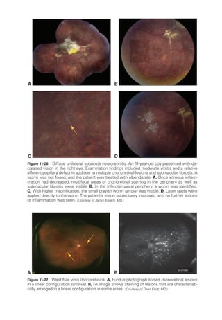 Figure 11-27 West Nile virus chorioretinitis. A, Fundus photo­
graph shows chorioret­
i­
nal lesions
in a linear configuration (arrows). B, FA image shows staining of lesions that are characteristi-
cally arranged in a linear configuration in some areas. (Courtesy of Dean Eliott, MD.)
A B
B
A
D
C
Figure 11-26 Diffuse unilateral subacute neuroretinitis. An 11-­
year-­
old boy presented with de-
creased vision in the right eye. Examination findings included moderate vitritis and a relative
afferent pupillary defect in addition to multiple chorioret­
i­
nal lesions and submacular fibrosis. A
worm was not found, and the patient was treated with albendazole. A, Once vitreous inflam-
mation had decreased, multifocal areas of chorioret­
i­
nal scarring in the periphery as well as
submacular fibrosis ­were vis­i­ble. B, In the inferotemporal periphery, a worm was identified.
C, With higher magnification, the small grayish worm (arrow) was vis­i­ble. D, ­
Laser spots ­
were
applied directly to the worm.The patient’s vision subjectively improved, and no further lesions
or inflammation was seen. (Courtesy of Jaclyn Kovach, MD.)
 