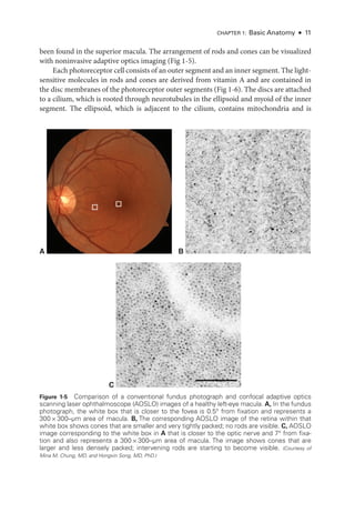 Chapter 1: Basic Anatomy ● 11
been found in the superior macula. The arrangement of rods and cones can be visualized
with noninvasive adaptive optics imaging (Fig 1-5).
Each photoreceptor cell consists of an outer segment and an inner segment. The light-­
sensitive molecules in rods and cones are derived from vitamin A and are contained in
the disc membranes of the photoreceptor outer segments (Fig 1-6). The discs are attached
to a cilium, which is rooted through neurotubules in the ellipsoid and myoid of the inner
segment. The ellipsoid, which is adjacent to the cilium, contains mitochondria and is
A B
C 100 μm
Figure 1-5 Comparison of a conventional fundus photo­
graph and confocal adaptive optics
scanning ­
laser ophthalmoscope (AOSLO) images of a healthy left-­
eye macula. A, In the fundus
photo­
graph, the white box that is closer to the fovea is 0.5° from fixation and represents a
300 × 300–­
μm area of macula. B, The corresponding AOSLO image of the ret­
ina within that
white box shows cones that are smaller and very tightly packed; no rods are vis­
i­
ble. C, AOSLO
image corresponding to the white box in A that is closer to the optic nerve and 7° from fixa-
tion and also represents a 300 × 300–­
μm area of macula. The image shows cones that are
larger and less densely packed; intervening rods are starting to become vis­
i­
ble. (Courtesy of
Mina M. Chung, MD, and Hongxin Song, MD, PhD.)
 