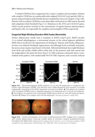 286 ● Retina and Vitreous
X-­
linked CSNB has been categorized into 2 types: complete and incomplete. Patients
with complete CSNB have an undetectable dark-­
adapted (DA) 0.01 (rod-­
specific) ERG re-
sponse and psychophysical thresholds that are mediated by cones (see Chapter 3, Fig 3-2B).
Patients with incomplete CSNB have some detectable rod function on ERG and an elevated
dark-­
adaptation final threshold (Fig 12-1). Mutations in the NYX and CACNA1F genes,
which encode proteins involved in the transmission of signals between photoreceptors
and bipolar cells, are responsible for complete and incomplete CSNB, respectively.
Congenital Night-­
Blinding Disorders With Fundus Abnormality
Fundus albipunctatus results from a mutation in RDH5 (12q13–­q14). RDH5 encodes
11-­
cis-­
retinol dehydrogenase, a microsomal enzyme in the ret­
i­
nal pigment epithelium
(RPE) that is involved in the regeneration of rhodopsin. Patients with fundus albipuncta-
tus have very delayed rhodopsin regeneration; and although levels eventually normalize,
the pro­cess may require many hours in the dark. Affected individuals have night blindness
from birth and usually exhibit yellow-­
white dots in the posterior pole that extend into
the midperiphery but spare the fovea (Fig 12-2). ERG responses commonly show a cone-­
isolated ret­
ina pattern, with undetectable DA 0.01 ERG response, and a severely reduced
C
40 μV
20 μV
–20 μV
–40 μV
0 200 ms
0 V
A
40 μV
20 μV
–20 μV
–40 μV
0 200 ms
0 V
B
Complete CSNB Incomplete CSNB Normal
200 ms
40 μV
20 μV
–20 μV
–40 μV
0
0 V
Figure 12-1 Electroretinography (ERG) patterns of on-­and off-­
responses in congenital sta-
tionary night blindness (CSNB). The stimulus has a 200-­
millisecond (ms) duration to enable
in­
de­
pen­
dent recording of the ERG responses to onset and offset. A, The pattern of a patient
with complete CSNB shows a negative-­
waveform on-­
response but a normal off-­
response.
B, The pattern of a patient with incomplete CSNB shows both on-­and off-­
response abnor-
malities. C, Pattern of a subject with normal responses. (Courtesy of Graham E. Holder, PhD.)
Figure 12-2 Fundus photo­
graphs and fundus autofluorescence (FAF) images from a patient
with fundus albipunctatus, showing multiple spots of unknown material scattered primarily
throughout the deep ret­
ina. (Reproduced from Sergouniotis PI, Sohn EH, Li Z, et al. Phenotypic variability in RDH5
retinopathy (fundus albipunctatus). Ophthalmology. 2011;118(8):1661–1670, with permission from Elsevier.)
 