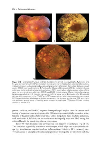 292 ● Retina and Vitreous
ge­
ne­
tic condition, and the ERG response shows prolonged implicit times. In conventional
testing of many rod–­
cone dystrophies, the ERG responses may initially pre­
sent as unde-
tectable or become undetectable over time. ­
Unless the patient has a treatable condition,
such as vitamin A deficiency or an autoimmune retinopathy, repetitive ERG testing has
minimal benefit for monitoring disease progression.
Sector RP refers to disease that involves only 1 or 2 sectors of the fundus (Fig 12-10).
This condition is generally symmetric between eyes, which helps rule out acquired dam-
age (eg, from trauma, vascular insult, or inflammation). Unilateral RP is extremely rare.
Typical ­
causes of unexplained unilateral pigmentary retinopathy are infection (rubella,
A B
C
Figure 12-6 Examples of fundus findings characteristic of rod–­
cone dystrophy. A, Fundus of a
54-­year-­old ­woman with USH2A mutation shows optic nerve head pallor, arteriolar attenuation,
macular atrophy, and widespread peripheral pigmentary alteration. Corrected distance visual
acuity (CDVA) was hand motions. B, Fundus of a 66-­
year-­
old man with USH2A mutation shows
extensive peripheral ret­
i­
nal pigment epithelium (RPE) atrophy but relative preservation of the
optic nerve, macula, and arterioles. CDVA was 20/30. Note the wide differences in phenotypes
between panels A and B, despite involvement of the same gene. C, Fundus of a 45-­
year-­
old
­
woman with mutations in the PCARE and CRB1 genes shows arteriolar attenuation, prominent
RPE hyperplasia (so-­
called bone spicules) posterior to the equator, and lacunar RPE atrophy in
the periphery. A tiny island of healthy ret­
ina remains in the fovea. CDVA was 20/100. (Courtesy
of Franco M. Recchia, MD.)
 