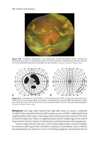 294 ● Retina and Vitreous
Figure 12-8 Exudative retinopathy and subsequent traction-­
exudative ret­
i­
nal detachment
complicating a case of USH2A-­
associated rod–­
cone dystrophy. Background arteriolar attenua-
tion and peripheral pigmentary changes are also pre­
sent. (Courtesy of Franco M. Recchia, MD.)
A B
Figure 12-9 Examples of visual fields in retinitis pigmentosa (RP), which were obtained with a
Goldmann III-4 test object. A, Early disease: midperipheral scotomata. B, Late disease: severe
loss, sparing only a central tunnel and a far-­
peripheral island, which may eventually dis­
appear.
(Courtesy of Michael F
. Marmor, MD.)
Management One large study reported that high daily doses of vitamin A palmitate
(15,000 IU/day) slowed the decline in ERG response in eyes with RP. A slight benefit from
supplementation with omega-3 and omega-6 fatty acids has also been reported. The mod-
est benefit of high-­
dose vitamin A supplementation must be weighed against the risks of
long-­
term liver toxicity, vitamin A–­
related intracranial hypertension, and teratogenicity.
Excessive light exposure may play a role in ret­
i­
nal degenerations caused by rhodop-
sin mutations and/or genes that contribute to lipofuscin accumulation, such as ABCA4.
Recommendations for patients to wear UV-­
absorbing sunglasses and brimmed hats for
 