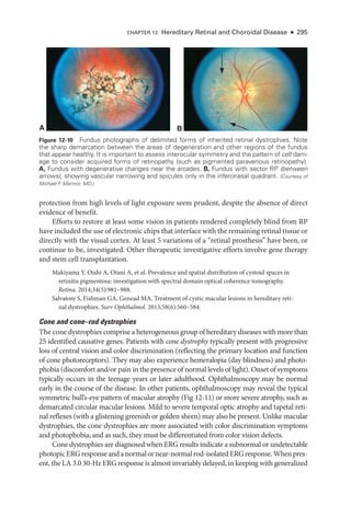 CHAPTER 12: Hereditary Ret­
i­
nal and Choroidal Disease ● 295
protection from high levels of light exposure seem prudent, despite the absence of direct
evidence of benefit.
Efforts to restore at least some vision in patients rendered completely blind from RP
have included the use of electronic chips that interface with the remaining ret­i­nal tissue or
directly with the visual cortex. At least 5 variations of a “ret­
i­
nal prosthesis” have been, or
continue to be, investigated. Other therapeutic investigative efforts involve gene therapy
and stem cell transplantation.
Makiyama Y, Oishi A, Otani A, et al. Prevalence and spatial distribution of cystoid spaces in
retinitis pigmentosa: investigation with spectral domain optical coherence tomography.
Ret­i­na. 2014;34(5):981–988.
Salvatore S, Fishman GA, Genead MA. Treatment of cystic macular lesions in hereditary ret­
i­
nal dystrophies. Surv Ophthalmol. 2013;58(6):560–584.
Cone and cone–­
rod dystrophies
The cone dystrophies comprise a heterogeneous group of hereditary diseases with more than
25 identified causative genes. Patients with cone dystrophy typically pre­
sent with progressive
loss of central vision and color discrimination (reflecting the primary location and function
of cone photoreceptors). They may also experience hemeralopia (day blindness) and photo-
phobia (discomfort and/or pain in the presence of normal levels of light). Onset of symptoms
typically occurs in the teenage years or ­
later adulthood. Ophthalmoscopy may be normal
early in the course of the disease. In other patients, ophthalmoscopy may reveal the typical
symmetric bull’s-­
eye pattern of macular atrophy (Fig 12-11) or more severe atrophy, such as
demarcated circular macular lesions. Mild to severe temporal optic atrophy and tapetal ret­
i­
nal reflexes (with a glistening greenish or golden sheen) may also be pre­
sent. Unlike macular
dystrophies, the cone dystrophies are more associated with color discrimination symptoms
and photophobia; and as such, they must be differentiated from color vision defects.
Cone dystrophies are diagnosed when ERG results indicate a subnormal or undetectable
photopicERGresponseandanormalornear-­normalrod-­isolatedERGresponse.Whenpres­
ent, the LA 3.0 30-­
Hz ERG response is almost invariably delayed, in keeping with generalized
A B
Figure 12-10 Fundus photo­
graphs of delimited forms of inherited ret­
i­
nal dystrophies. Note
the sharp demarcation between the areas of degeneration and other regions of the fundus
that appear healthy. It is impor­
tant to assess interocular symmetry and the pattern of cell dam-
age to consider acquired forms of retinopathy (such as pigmented paravenous retinopathy).
A, Fundus with degenerative changes near the arcades. B, Fundus with sector RP (between
arrows), showing vascular narrowing and spicules only in the inferonasal quadrant. (Courtesy of
Michael F
. Marmor, MD.)
 