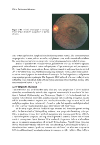 296 ● Retina and Vitreous
cone system dysfunction. Peripheral visual fields may remain normal. The cone dystrophies
are progressive. In some patients, secondary rod photoreceptor involvement develops in ­
later
life, suggesting overlap between progressive cone dystrophies and cone–­
rod dystrophies.
Similar to patients with cone dystrophies, patients with cone–­rod dystrophies typically
pre­
sent with reduced central vision and symptoms of dyschromatopsia and photophobia.
On visual field testing, some patients show a tight ring or central scotoma within the central
20° or 30° of the visual field. Ophthalmoscopy may initially be normal; ­
later, it may demon-
strate intraret­
i­
nal pigment in areas of ret­
i­
nal atrophy in the fundus periphery, and patients
may report progressive nyctalopia. The diagnostic ERG hallmark of a cone–­
rod dystrophy
is that the cone-­
derived full-­
field ERG responses are more subnormal than the rod ERG
responses (see Chapter 3, Fig 3-2).
Leber congenital amaurosis
The dystrophies that are typified by early onset and rapid progression of severe bilateral
vision loss are collectively termed Leber congenital amaurosis (LCA; see also BCSC Sec-
tion 6, Pediatric Ophthalmology and Strabismus, Chapter 24). LCA is characterized by
severely reduced vision from birth, usually associated with wandering nystagmus. Infants
exhibit ­limited to no visual response, and visual acuities tend to range between 20/200 and
no light perception. Some infants with LCA rub or poke their eyes (the oculodigital reflex)
in order to create visual stimulation, as do other infants with poor vision.
In the early stages, obvious fundus changes are rare, and molecular ge­
ne­
tic testing
offers the best method of distinguishing stationary and progressive hereditary retinopa-
thies. In addition, ­
because ­
there are both syndromic and nonsyndromic forms of LCA,
a molecular ge­
ne­
tic diagnosis can help identify potential systemic features that warrant
medical management. Some forms of LCA involve developmental defects, while ­
others
appear to represent degenerations of normally formed ret­
ina. Postinfectious etiologies
should be considered based on history and clinical findings. Central macular atrophic le-
sions (sometimes incorrectly referred to as macular colobomas) are often seen in eyes with
LCA, in addition to early-­onset cataracts and keratoconus in older ­children. Most ­children
Figure 12-11 Fundus photo­
graph of cone dys-
trophy shows the bull’s-­
eye pattern of central
atrophy.
 