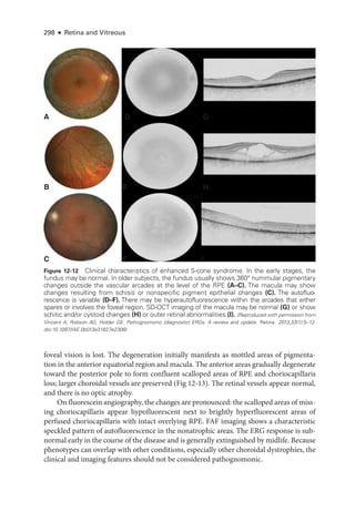 298 ● Retina and Vitreous
foveal vision is lost. The degeneration initially manifests as mottled areas of pigmenta-
tion in the anterior equatorial region and macula. The anterior areas gradually degenerate
­
toward the posterior pole to form confluent scalloped areas of RPE and choriocapillaris
loss; larger choroidal vessels are preserved (Fig 12-13). The ret­
i­
nal vessels appear normal,
and ­
there is no optic atrophy.
On fluorescein angiography, the changes are pronounced: the scalloped areas of miss-
ing choriocapillaris appear hypofluorescent next to brightly hyperfluorescent areas of
perfused choriocapillaris with intact overlying RPE. FAF imaging shows a characteristic
speckled pattern of autofluorescence in the nonatrophic areas. The ERG response is sub-
normal early in the course of the disease and is generally extinguished by midlife. ­
Because
phenotypes can overlap with other conditions, especially other choroidal dystrophies, the
clinical and imaging features should not be considered pathognomonic.
A
B
C
D G
E H
F I
Figure 12-12 Clinical characteristics of enhanced S-­
cone syndrome. In the early stages, the
fundus may be normal. In older subjects, the fundus usually shows 360° nummular pigmentary
changes outside the vascular arcades at the level of the RPE (A–­C). The macula may show
changes resulting from schisis or nonspecific pigment epithelial changes (C). The autofluo-
rescence is variable (D–­F). ­
There may be hyperautofluorescence within the arcades that ­
either
spares or involves the foveal region. SD-­
OCT imaging of the macula may be normal (G) or show
schitic and/or cystoid changes (H) or outer ret­
i­
nal abnormalities (I). (Reproduced with permission from
Vincent A, Robson AG, Holder GE. Pathognomonic (diagnostic) ERGs. A review and update. Ret­i­na. 2013;33(1):5–12.
doi:10.1097/IAE.0b013e31827e2306)
 