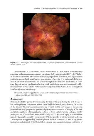 CHAPTER 12: Hereditary Ret­
i­
nal and Choroidal Disease ● 299
Choroideremia is X-­
linked and caused by mutations in CHM, which is constitutively
expressed and encodes geranylgeranyl transferase Rab escort protein (REP1). REP1 plays
an essential role in the intracellular trafficking of proteins, substrates, and organelles by
mediating proper lipid modification (prenylation) of specific G proteins called Rab pro-
teins. Carriers of choroideremia are usually asymptomatic and have normal ERGs. How-
ever, they often show patches of subret­
i­
nal black mottled pigment, and occasionally, older
female carriers show a lobular pattern of choriocapillaris and RPE loss. Gene therapy ­trials
for choroideremia are ongoing.
Edwards TL, Jolly JK, Groppe M, et al. Visual acuity ­
after ret­
i­
nal gene therapy for choroideremia.
N Engl J Med. 2016;374(20):1996–1998.
Gyrate atrophy
Patients affected by gyrate atrophy usually develop nyctalopia during the first de­
cade of
life and experience progressive loss of visual field and visual acuity ­
later in the course
of the disease. Macular edema is commonly pre­
sent. In the early stages of the disease,
patients have large, geographic, peripheral paving-­
stone–­
like areas of atrophy of the RPE
and choriocapillaris, which gradually coalesce to form a characteristic scalloped border
at the junction of normal and abnormal RPE (Fig 12-14). Gyrate atrophy is an autosomal
recessive dystrophy caused by mutations in OAT, the gene for ornithine aminotransferase.
The diagnosis is supported by elevated plasma levels of ornithine, as well as by ge­
ne­
tic
testing for mutations of OAT. If started at a young age, aggressive dietary restriction of
Figure 12-13 Montage fundus photo­
graph of a 22-­
year-­
old patient with choroideremia. (Courtesy
of Cagri G. Besirli, MD.)
 