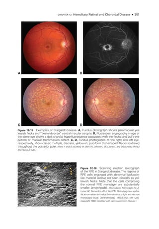 CHAPTER 12: Hereditary Ret­
i­
nal and Choroidal Disease ● 301
A B
C D
Figure 12-15 Examples of Stargardt disease. A, Fundus photo­
graph shows paramacular yel-
lowish flecks and “beaten-­
bronze” central macular atrophy. B, Fluorescein angiography image of
the same eye shows a dark choroid, hyperfluorescence associated with the flecks, and bull’s-­
eye
pattern of macular transmission defect. C, D, Fundus photo­
graphs of the right and left eye,
respectively, show classic multiple, discrete, yellowish, pisciform (fish-­
shaped) flecks scattered
throughout the posterior pole. (Parts A and B courtesy of Mark W. Johnson, MD; parts C and D courtesy of Paul
Sternberg Jr, MD.)
Figure 12-16 Scanning electron micrograph
of the RPE in Stargardt disease.The regions of
RPE cells engorged with abnormal lipofuscin-­
like material (arrow) are seen clinically as yel-
lowish flecks. Note that the cells comprising
the normal RPE monolayer are substantially
smaller (arrowheads). (Reproduced from Ea­
gle RC Jr,
Lucier AC, BernardinoVB Jr,Yanoff M. Ret­
i­
nal pigment epithe-
lial abnormalities in fundus flavimaculatus: a light and electron
microscopic study. Ophthalmology. 1980;87(12):1189–1200.
Copyright 1980, modified with permission from Elsevier.)
 