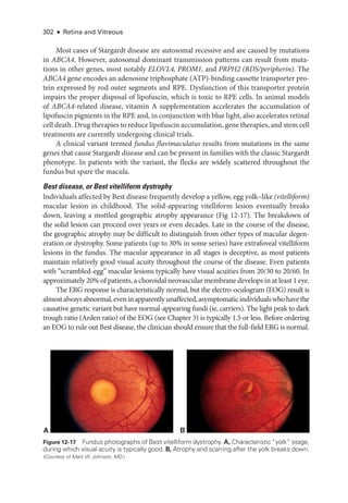302 ● Retina and Vitreous
Most cases of Stargardt disease are autosomal recessive and are caused by mutations
in ABCA4. However, autosomal dominant transmission patterns can result from muta-
tions in other genes, most notably ELOVL4, PROM1, and PRPH2 (RDS/peripherin). The
ABCA4 gene encodes an adenosine triphosphate (ATP)-­
binding cassette transporter pro-
tein expressed by rod outer segments and RPE. Dysfunction of this transporter protein
impairs the proper disposal of lipofuscin, which is toxic to RPE cells. In animal models
of ABCA4-­
related disease, vitamin A supplementation accelerates the accumulation of
lipofuscin pigments in the RPE and, in conjunction with blue light, also accelerates ret­i­nal
cell death. Drug therapies to reduce lipofuscin accumulation, gene therapies, and stem cell
treatments are currently undergoing clinical ­
trials.
A clinical variant termed fundus flavimaculatus results from mutations in the same
genes that cause Stargardt disease and can be pre­
sent in families with the classic Stargardt
phenotype. In patients with the variant, the flecks are widely scattered throughout the
fundus but spare the macula.
Best disease, or Best vitelliform dystrophy
Individuals affected by Best disease frequently develop a yellow, egg yolk–­
like (vitelliform)
macular lesion in childhood. The solid-­
appearing vitelliform lesion eventually breaks
down, leaving a mottled geographic atrophy appearance (Fig 12-17). The breakdown of
the solid lesion can proceed over years or even de­
cades. Late in the course of the disease,
the geographic atrophy may be difficult to distinguish from other types of macular degen-
eration or dystrophy. Some patients (up to 30% in some series) have extrafoveal vitelliform
lesions in the fundus. The macular appearance in all stages is deceptive, as most patients
maintain relatively good visual acuity throughout the course of the disease. Even patients
with “scrambled-­
egg” macular lesions typically have visual acuities from 20/30 to 20/60. In
approximately 20% of patients, a choroidal neovascular membrane develops in at least 1 eye.
The ERG response is characteristically normal, but the electro-­
oculogram (EOG) result is
almostalwaysabnormal,eveninapparentlyunaffected,asymptomaticindividualswhohavethe
causative ge­
ne­
tic variant but have normal-­
appearing fundi (ie, carriers). The light peak to dark
trough ratio (Arden ratio) of the EOG (see Chapter 3) is typically 1.5 or less. Before ordering
an EOG to rule out Best disease, the clinician should ensure that the full-­
field ERG is normal.
A B
Figure 12-17 Fundus photo­
graphs of Best vitelliform dystrophy. A, Characteristic “yolk” stage,
during which visual acuity is typically good. B, Atrophy and scarring ­
after the yolk breaks down.
(Courtesy of Mark W. Johnson, MD.)
 