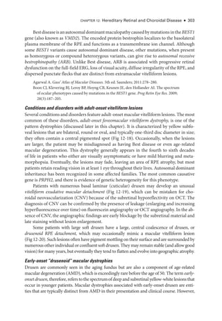 CHAPTER 12: Hereditary Ret­
i­
nal and Choroidal Disease ● 303
Best disease is an autosomal dominant maculopathy caused by mutations in the BEST1
gene (also known as VMD2). The encoded protein bestrophin localizes to the basolateral
plasma membrane of the RPE and functions as a transmembrane ion channel. Although
some BEST1 variants cause autosomal dominant disease, other mutations, when pre­
sent
as homozygous or compound heterozygous variants, can give rise to autosomal recessive
bestrophinopathy (ARB). Unlike Best disease, ARB is associated with progressive ret­
i­
nal
dysfunction on the full-­field ERG, loss of visual acuity, diffuse irregularity of the RPE, and
dispersed punctate flecks that are distinct from extramacular vitelliform lesions.
Agarwal A. Gass’ Atlas of Macular Diseases. 5th ed. Saunders; 2011:278–280.
Boon CJ, Klevering BJ, Leroy BP, Hoyng CB, Keunen JE, den Hollander AI. The spectrum
of ocular phenotypes caused by mutations in the BEST1 gene. Prog Retin Eye Res. 2009;
28(3):187–205.
Conditions and disorders with adult-­
onset vitelliform lesions
Several conditions and disorders feature adult-­onset macular vitelliform lesions. The most
common of ­
these disorders, adult-­
onset foveomacular vitelliform dystrophy, is one of the
pattern dystrophies (discussed ­
later in this chapter). It is characterized by yellow subfo-
veal lesions that are bilateral, round or oval, and typically one-­
third disc dia­
meter in size;
they often contain a central pigmented spot (Fig 12-18). Occasionally, when the lesions
are larger, the patient may be misdiagnosed as having Best disease or even age-­
related
macular degeneration. This dystrophy generally appears in the fourth to sixth de­
cades
of life in patients who ­
either are visually asymptomatic or have mild blurring and meta-
morphopsia. Eventually, the lesions may fade, leaving an area of RPE atrophy, but most
patients retain reading vision in at least 1 eye throughout their lives. Autosomal dominant
inheritance has been recognized in some affected families. The most common causative
gene is PRPH2, and ­
there is evidence of ge­
ne­
tic heterogeneity for this phenotype.
Patients with numerous basal laminar (cuticular) drusen may develop an unusual
vitelliform exudative macular detachment (Fig 12-19), which can be mistaken for cho-
roidal neovascularization (CNV) ­
because of the subret­
i­
nal hyporeflectivity on OCT. The
diagnosis of CNV can be confirmed by the presence of leakage (enlarging and increasing
hyperfluorescence over time) on fluorescein angiography or OCT angiography. In the ab-
sence of CNV, the angiographic findings are early blockage by the subret­
i­
nal material and
late staining without lesion enlargement.
Some patients with large soft drusen have a large, central coalescence of drusen, or
drusenoid RPE detachment, which may occasionally mimic a macular vitelliform lesion
(Fig 12-20). Such lesions often have pigment mottling on their surface and are surrounded by
numerous other individual or confluent soft drusen. They may remain stable (and allow good
vision) for many years, but eventually they tend to flatten and evolve into geographic atrophy.
Early-­
onset “drusenoid” macular dystrophies
Drusen are commonly seen in the aging fundus but are also a component of age-­
related
macular degeneration (AMD), which is exceedingly rare before the age of 50. The term early-­
onset drusen, therefore, refers to the spectrum of deep and subret­i­nal yellow-­white lesions that
occur in younger patients. Macular dystrophies associated with early-­
onset drusen are enti-
ties that are typically distinct from AMD in their pre­
sen­
ta­
tion and clinical course. However,
 