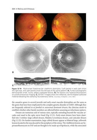 304 ● Retina and Vitreous
A
B
C
Figure 12-18 Adult-­
onset foveomacular vitelliform dystrophy. (Left panels in each part show
the right eye, and right panels show the left eye of the same patient.) A, Fundus photo­
graphs
demonstrate small, round, yellow subfoveal lesions. B, The lesions are hyperautofluorescent
on autofluorescence imaging. C, SD-­
OCT images show the reflective, dome-­
shaped subfoveal
material elevating the overlying neurosensory ret­
ina. (Courtesy of Stephen J. Kim, MD.)
the causative genes in several juvenile and early-­
onset macular dystrophies are the same as
the genes that have been implicated in the complex ge­
ne­
tic disorder of AMD. Although they
are frequently referred to as familial or autosomal dominant drusen, the clinician needs to
establish ­
whether other ­
family members are affected before assuming an inheritance pattern.
Drusen are numerous and of vari­
ous sizes, typically extending beyond the vascular ar-
cades and nasal to the optic nerve head (Fig 12-21). Early-­
onset drusen have been classi-
fied into 3 entities: large colloid drusen, Malattia Leventinese drusen, and cuticular drusen
(Fig 12-22). On fundus examination, large colloid drusen appear as bilateral large, yellowish
lesions located in the macula and/or the periphery of the ret­ina. The vitelliform lesions are hy-
perautofluorescent on FAF and are thought to be made up of lipofuscin, while the associated
 