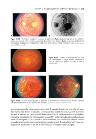 CHAPTER 12: Hereditary Ret­
i­
nal and Choroidal Disease ● 305
surrounding cuticular drusen and/or subret­
i­
nal drusenoid deposits are generally not auto-
fluorescent. The drusen of Malattia Leventinese (also called Doyne honeycomb dystrophy)
often show a distinctive pattern of radial extensions of small and intermediate-­
sized deposits
emanating from the fovea. The condition is caused by a shared single autosomal dominant
mutation in the gene EFEMP1, which to date has not been associated with AMD risk. Patients
generally retain good central visual acuity through their sixth de­
cade, ­
after which visual acu-
ity generally deteriorates to 20/200 or worse ­
because of progressive RPE atrophy.
A B
Figure 12-19 Vitelliform exudative macular detachment. A, Fundus photo­
graph of a vitelliform
lesion associated with numerous cuticular (basal laminar) drusen. B, Corresponding late-­
phase
fluorescein angiography image shows staining of the drusen and vitelliform lesion. (Courtesy of
Michael F
. Marmor, MD.)
Figure 12-20 Fundus photo­
graph shows cen-
tral coalescence of large drusen simulating a
macular vitelliform lesion. (Courtesy of Mark W.
Johnson, MD.)
Figure 12-21 Fundus photo­
graphs of dif­
fer­
ent manifestations of early-­
onset drusen. Variable
size and distribution of the drusen are evident. (Courtesy of Michael F
. Marmor, MD.)
 