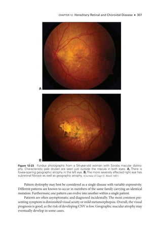 CHAPTER 12: Hereditary Ret­
i­
nal and Choroidal Disease ● 307
Pattern dystrophy may best be considered as a single disease with variable expressivity.
Dif­
fer­
ent patterns are known to occur in members of the same ­
family carry­
ing an identical
mutation. Furthermore, one pattern can evolve into another within a single patient.
Patients are often asymptomatic and diagnosed incidentally. The most common pre-
senting symptom is diminished visual acuity or mild metamorphopsia. Overall, the visual
prognosis is good, as the risk of developing CNV is low. Geographic macular atrophy may
eventually develop in some cases.
A
B
Figure 12-23 Fundus photo­
graphs from a 54-­
year-­
old ­
woman with Sorsby macular dystro-
phy. Characteristic pale drusen are seen just outside the macula in both eyes. A, ­There is
fovea-­
sparing geographic atrophy in the left eye. B, The more severely affected right eye has
subret­
i­
nal fibrosis as well as geographic atrophy. (Courtesy of Cagri G. Besirli, MD.)
 