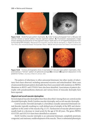 308 ● Retina and Vitreous
The pattern of inheritance is often autosomal dominant, but other modes of inheri-
tance have been observed, including autosomal recessive and mitochondrial. Most cases
of autosomal dominant pattern dystrophy have been associated with mutations in PRPH2.
Mutations in BEST1 and CTNNA1 have also been identified. Associations of pattern dys-
trophy with pseudoxanthoma elasticum and vari­
ous forms of muscular dystrophy have
been reported.
Aty­
pi­
cal and occult macular dystrophies
Several aty­pi­cal macular dystrophies have been described. Among them are central areolar
choroidal dystrophy, North Carolina macular dystrophy, and occult macular dystrophy.
Central areolar choroidal dystrophy is a hereditary (usually autosomal dominant) ret­
i­
nal disorder typically resulting in a well-­
defined area of atrophy of the RPE and chorio-
capillaris in the center of the macula (Fig 12-27). Dysfunction of macular photoreceptors
usually leads to a decrease in visual acuity by the age of 30–60 years. The genes PRPH2,
GUCY2D, and GUCA1A have been identified as causative.
North Carolina macular dystrophy is an autosomal dominant, completely penetrant,
congenital, and stationary maldevelopment of the macula. ­There is substantial phenotypic
A B
A B
Figure 12-24 Butterfly-­
type pattern dystrophy. A, Color fundus photo­
graph from a 56-­
year-­
old
­
woman shows a typical yellow macular pigment pattern. B, Fluorescein angiography image
shows blocked fluorescence of the pigment lesion itself and a rim of hyperfluorescence from
surrounding RPE atrophy. (Reproduced from Song M-­
K, Small KW. Macular dystrophies. In: Regillo CD, Brown GC,
Flynn HW Jr, eds. Vitreoret­i­nal Disease:The Essentials.Thieme; 1999:297
. With permission fromThieme. www​.­thieme​.­com)
Figure 12-25 Fundus photo­
graphs show 2 examples of reticular-­
type pattern dystrophy, char-
acterized by a “fishnet” pattern of yellowish-­
orange (A) or brown (B) pigment deposition in the
posterior fundus. (Courtesy of Mark W. Johnson, MD.)
 