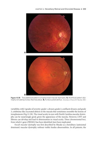 CHAPTER 12: Hereditary Ret­
i­
nal and Choroidal Disease ● 309
variability, with 3 grades of severity: grade 1, drusen; grade 2, confluent drusen; and grade
3, coloboma-­
like excavated defects in the macula that sometimes resemble the lesions of
toxoplasmosis (Fig 12-28). The visual acuity in eyes with North Carolina macular dystro-
phy can be surprisingly good, given the appearance of the macula. However, CNV and
fibrosis can develop and lead to deterioration in visual acuity. Three chromosomal loci,
from which 1 gene (PROM1) has been identified, have been implicated.
Occult macular dystrophy was first described by Miyake as a hereditary (autosomal
dominant) macular dystrophy without vis­
i­
ble fundus abnormalities. In all patients, the
A
B
Figure 12-26 Two additional patterns of early-­
onset macular dystrophy. A, Multifocal pattern dys-
trophy simulating fundus flavimaculatus. B, Fundus pulverulentus. (Courtesy of Franco M. Recchia, MD.)
 