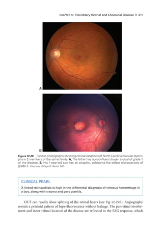 CHAPTER 12: Hereditary Ret­
i­
nal and Choroidal Disease ● 311
CLINICAL PEARL
X-­
linked retinoschisis is high in the differential diagnosis of vitreous hemorrhage in
a boy, along with trauma and pars planitis.
OCT can readily show splitting of the ret­
i­
nal layers (see Fig 12-29B). Angiography
reveals a petaloid pattern of hyperfluorescence without leakage. The panret­
i­
nal involve-
ment and inner ret­
i­
nal location of the disease are reflected in the ERG response, which
A
B
Figure 12-28 Fundus photo­
graphs showing clinical variations of North Carolina macular dystro-
phy in 2 members of the same ­
family. A,The ­
father has nonconfluent drusen typical of grade 1
of the disease. B, His 1-­
year-­
old son has an atrophic, coloboma-­
like defect characteristic of
grade 3. (Courtesy of Cagri G. Besirli, MD.)
 