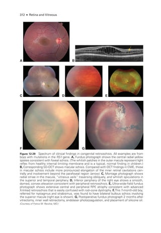 312 ● Retina and Vitreous
C D E
A B
F G
Figure 12-29 Spectrum of clinical findings in congenital retinoschisis. All examples are from
boys with mutations in the RS1 gene. A, Fundus photo­
graph shows the central radial yellow
spokes consistent with foveal schisis. (The whitish patches in the outer macula represent light
reflex from healthy internal limiting membrane and is a typical, normal finding in ­
children.)
B, Corresponding SD-­
OCT shows macular schisis. Compared with OCT findings in CME, ­
those
in macular schisis include more pronounced elongation of the inner ret­
i­
nal cavitations cen-
trally and involvement beyond the parafoveal region (arrow). C, Montage photo­
graph shows
radial striae in the macula, “vitreous veils” traversing obliquely, and whitish spiculations in
the superior and temporal periphery. D, Inferior periphery of the right eye shows a smooth,
domed, convex elevation consistent with peripheral retinoschisis. E, Ultra-­wide-­field fundus
photo­
graph shows extensive central and peripheral RPE atrophy consistent with advanced
X-­
linked retinoschisis that is easily confused with rod–­
cone dystrophy. F,This 7-­month-­old boy,
referred for nystagmus and strabismus, was found to have bilateral bullous schisis involving
the superior macula (right eye is shown). G, Postoperative fundus photo­
graph 2 months ­
after
vitrectomy, inner wall retinectomy, endolaser photocoagulation, and placement of silicone oil.
(Courtesy of Franco M. Recchia, MD.)
 
