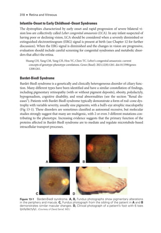 318 ● Retina and Vitreous
Infantile-­
Onset to Early Childhood–­
Onset Syndromes
The dystrophies characterized by early onset and rapid progression of severe bilateral vi-
sion loss are collectively called Leber congenital amaurosis (LCA). In any infant suspected of
having poor or declining vision, LCA should be considered when a severely diminished or
extinguished electroretinogram (ERG) signal is pre­
sent at birth (see Chapter 12 for further
discussion). When the ERG signal is diminished and the changes in vision are progressive,
evaluation should include careful screening for congenital syndromes and metabolic disor-
ders that affect the ret­
ina.
Huang CH, Yang CM, Yang CH, Hou YC, Chen TC. Leber’s congenital amaurosis: current
concepts of genotype-­
phenotype correlations. Genes (Basel). 2021;12(8):1261. doi:10.3390/genes​
12081261.
Bardet-­Biedl Syndrome
Bardet-­
Biedl syndrome is a genet­
ically and clinically heterogeneous disorder of ciliary func-
tion. Many dif­
fer­
ent types have been identified and have a similar constellation of findings,
including pigmentary retinopathy (with or without pigment deposits), obesity, polydactyly,
hypogonadism, cognitive disability, and renal abnormalities (see the section “Renal dis-
eases”). Patients with Bardet-­
Biedl syndrome typically demonstrate a form of rod–­
cone dys-
trophy with variable severity, usually sine pigmento, with a bull’s-­
eye atrophic maculopathy
(Fig 13-1). ­
These disorders are sometimes classified as autosomal recessive, but molecular
studies strongly suggest that many are multigenic, with 2 or even 3 dif­
fer­
ent mutations con-
tributing to the phenotype. Increasing evidence suggests that the primary function of the
proteins affected in Bardet-­
Biedl syndrome are to mediate and regulate microtubule-­
based
intracellular transport pro­
cesses.
A B
D
C
Figure 13-1 Bardet-­Biedl syndrome. A, B, Fundus photo­
graphs show pigmentary alterations
in the periphery and macula. C, Fundus photo­
graph from the sibling of the patient in A and B
demonstrates similar macular changes. D, Clinical photo­
graph of a patient’s foot with 6 toes
(polydactyly). (Courtesy of David Sarraf, MD.)
 