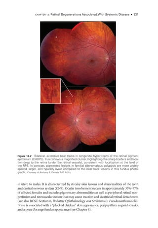 in utero to males. It is characterized by streaky skin lesions and abnormalities of the teeth
and central ner­
vous system (CNS). Ocular involvement occurs in approximately 35%–77%
of affected females and includes pigmentary abnormalities as well as peripheral ret­
i­
nal non-
perfusion and neovascularization that may cause traction and cicatricial ret­
i­
nal detachment
(see also BCSC Section 6, Pediatric Ophthalmology and Strabismus). Pseudoxanthoma elas-
ticum is associated with a “plucked chicken” skin appearance, peripapillary angioid streaks,
and a peau d’orange fundus appearance (see Chapter 4).
Figure 13-2 Bilateral, extensive bear tracks in congenital hypertrophy of the ret­
i­
nal pigment
epithelium (CHRPE). Inset shows a magnified cluster, highlighting the sharp borders and loca-
tion deep to the ret­
ina (­
under the ret­
i­
nal vessels), consistent with localization at the level of
the RPE. In contrast, pigmented lesions in familial adenomatous polyposis are more widely
spaced, larger, and typically ovoid compared to the bear track lesions in this fundus photo­
graph. (Courtesy of Anthony B. Daniels, MD, MSc.)
Chapter 13: Ret­
i­
nal Degenerations Associated With Systemic Disease ● 321
 