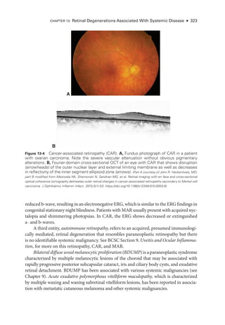 reduced b-­wave, resulting in an electronegative ERG, which is similar to the ERG findings in
congenital stationary night blindness. Patients with MAR usually pre­sent with acquired nyc-
talopia and shimmering photopsias. In CAR, the ERG shows decreased or extinguished
a-­ and b-­waves.
A third entity, autoimmune retinopathy, refers to an acquired, presumed immunologi-
cally mediated, ret­
i­
nal degeneration that resembles paraneoplastic retinopathy but ­
there
is no identifiable systemic malignancy. See BCSC Section 9, Uveitis and Ocular Inflamma-
tion, for more on this retinopathy, CAR, and MAR.
Bilateral diffuse uveal melanocytic proliferation (BDUMP) is a paraneoplasticsyndrome
characterized by multiple melanocytic lesions of the choroid that may be associated with
rapidly progressive posterior subcapsular cataract, iris and ciliary body cysts, and exudative
ret­
i­
nal detachment. BDUMP has been associated with vari­
ous systemic malignancies (see
Chapter 9). Acute exudative polymorphous vitelliform maculopathy, which is characterized
by multiple waxing and waning subret­
i­
nal vitelliform lesions, has been reported in associa-
tion with metastatic cutaneous melanoma and other systemic malignancies.
A
B
Figure 13-4 Cancer-­
associated retinopathy (CAR). A, Fundus photo­
graph of CAR in a patient
with ovarian carcinoma. Note the severe vascular attenuation without obvious pigmentary
alterations. B, Fourier-­
domain cross-­
sectional OCT of an eye with CAR that shows disruption
(arrowheads) of the outer nuclear layer and external limiting membrane as well as decreases
in reflectivity of the inner segment ellipsoid zone (arrows). (Part A courtesy of John R. Heckenlively, MD;
part B modified from Mesiwala NK, Shemonski N, Sandrian MG, et al. Ret­
i­
nal imaging with en face and cross-­
sectional
optical coherence tomography delineates outer ret­
i­
nal changes in cancer-­
associated retinopathy secondary to Merkel cell
carcinoma. J Ophthalmic Inflamm Infect. 2015;5(1):53. https://doi.org/10.1186/s12348-015-0053-0)
Chapter 13: Ret­
i­
nal Degenerations Associated With Systemic Disease ● 323
 