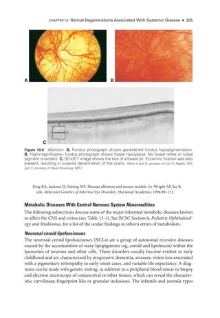 King RA, Jackson IJ, Oetting WS. ­
Human albinism and mouse models. In: Wright AF, Jay B,
eds. Molecular Ge­
ne­
tics of Inherited Eye Disorders. Harwood Academic; 1994:89–122.
Metabolic Diseases With Central Ner­
vous System Abnormalities
The following subsections discuss some of the major inherited metabolic diseases known
to affect the CNS and ret­
ina (see ­
Table 13-1). See BCSC Section 6, Pediatric Ophthalmol-
ogy and Strabismus, for a list of the ocular findings in inborn errors of metabolism.
Neuronal ceroid lipofuscinoses
The neuronal ceroid lipofuscinoses (NCLs) are a group of autosomal recessive diseases
caused by the accumulation of waxy lipopigments (eg, ceroid and lipofuscin) within the
lysosomes of neurons and other cells. ­
These disorders usually become evident in early
childhood and are characterized by progressive dementia, seizures, vision loss associated
with a pigmentary retinopathy in early-­
onset cases, and variable life expectancy. A diag-
nosis can be made with ge­
ne­
tic testing, in addition to a peripheral blood smear or biopsy
and electron microscopy of conjunctival or other tissues, which can reveal the character-
istic curvilinear, fingerprint-­
like or granular inclusions. The infantile and juvenile types
A B
C
Figure 13-5 Albinism. A, Fundus photo­
graph shows generalized fundus hypopigmentation.
B, High-­
magnification fundus photo­
graph shows foveal hypoplasia. No foveal reflex or luteal
pigment is evident. C, SD-­
OCT image shows the lack of a foveal pit. Eccentric fixation was also
pre­
sent, resulting in superior decentration of the scans. (Parts A and B courtesy of Carl D. Regillo, MD;
part C courtesy of David Browning, MD.)
Chapter 13: Ret­
i­
nal Degenerations Associated With Systemic Disease ● 325
 