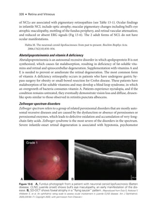 326 ● Retina and Vitreous
of NCLs are associated with pigmentary retinopathies (see ­
Table 13-1). Ocular findings
in infantile NCL include optic atrophy; macular pigmentary changes including bull’s-­
eye
atrophic maculopathy, mottling of the fundus periphery, and ret­
i­
nal vascular attenuation;
and reduced or absent ERG signals (Fig 13-6). The 2 adult forms of NCL do not have
ocular manifestations.
Haltia M. The neuronal ceroid-­
lipofuscinoses: from past to pre­
sent. Biochim Biophys Acta.
2006;1762(10):850–856.
Abetalipoproteinemia and vitamin A deficiency
Abetalipoproteinemia is an autosomal recessive disorder in which apolipoprotein B is not
synthesized, which ­
causes fat malabsorption, resulting in deficiency of fat-­
soluble vita-
mins and ret­
i­
nal and spinocerebellar degeneration. Supplementation with vitamins A and
E is needed to prevent or ameliorate the ret­
i­
nal degeneration. The most common form
of vitamin A deficiency retinopathy occurs in patients who have under­
gone gastric by-
pass surgery for obesity or small-­
bowel resection for Crohn disease. ­
These patients have
malabsorption of fat-­
soluble vitamins and may develop a blind loop syndrome, in which
an overgrowth of bacteria consumes vitamin A. Patients experience nyctalopia, and if the
condition remains untreated, they eventually demonstrate vision loss and diffuse, drusen-
like spots similar to ­
those observed in retinitis punctata albescens.
Zellweger spectrum disorders
Zellweger spectrum refers to a group of related peroxisomal disorders that are mostly auto-
somal recessive diseases and are caused by the dysfunction or absence of peroxisomes or
peroxisomal enzymes, which leads to defective oxidation and accumulation of very-­
long-­
chain fatty acids. Zellweger syndrome is the most severe of the disorders in the spectrum.
Severe infantile-­
onset ret­
i­
nal degeneration is associated with hypotonia, psychomotor
A B
Grade 1
200 μm
Figure 13-6 A, Fundus photo­
graph from a patient with neuronal ceroid lipofuscinosis (Batten
disease; CLN3, juvenile onset) shows bull’s eye maculopathy, an early manifestation of the dis-
ease. B, SD-­
OCT shows foveal atrophy in a “flying saucer” pattern. (Reproduced from Dulz S, Atiskova Y,
Wibbeler E, et al. An ophthalmic rating scale to assess ocular involvement in juvenile CLN3 disease. Am J Ophthalmol.
2020;220:64–71. Copyright 2020, with permission from Elsevier.)
 
