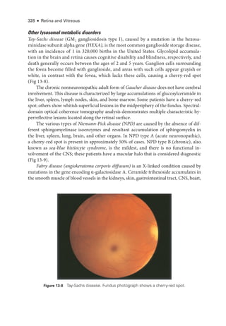 328 ● Retina and Vitreous
Other lysosomal metabolic disorders
Tay-­Sachs disease (GM2 gangliosidosis type I), caused by a mutation in the hexosa-
minidase subunit alpha gene (HEXA), is the most common ganglioside storage disease,
with an incidence of 1 in 320,000 births in the United States. Glycolipid accumula-
tion in the brain and ret­
ina ­
causes cognitive disability and blindness, respectively, and
death generally occurs between the ages of 2 and 5 years. Ganglion cells surrounding
the fovea become filled with ganglioside, and areas with such cells appear grayish or
white, in contrast with the fovea, which lacks ­
these cells, causing a cherry-­
red spot
(Fig 13-8).
The chronic nonneuronopathic adult form of Gaucher disease does not have ce­
re­
bral
involvement. This disease is characterized by large accumulations of glucosylceramide in
the liver, spleen, lymph nodes, skin, and bone marrow. Some patients have a cherry-­
red
spot; ­
others show whitish superficial lesions in the midperiphery of the fundus. Spectral-­
domain optical coherence tomography analy­
sis demonstrates multiple characteristic hy-
perreflective lesions located along the ret­
i­
nal surface.
The vari­
ous types of Niemann-­
Pick disease (NPD) are caused by the absence of dif­
fer­
ent sphingomyelinase isoenzymes and resultant accumulation of sphingomyelin in
the liver, spleen, lung, brain, and other organs. In NPD type A (acute neuronopathic),
a cherry-­
red spot is pre­
sent in approximately 50% of cases. NPD type B (chronic), also
known as sea-­
blue histiocyte syndrome, is the mildest, and ­
there is no functional in-
volvement of the CNS; ­
these patients have a macular halo that is considered diagnostic
(Fig 13-9).
Fabry disease (angiokeratoma corporis diffusum) is an X-­
linked condition caused by
mutations in the gene encoding α-­
galactosidase A. Ceramide trihexoside accumulates in
the smooth muscle of blood vessels in the kidneys, skin, gastrointestinal tract, CNS, heart,
Figure 13-8 Tay-­
Sachs disease. Fundus photo­
graph shows a cherry-­
red spot.
 