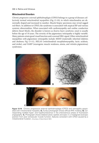 330 ● Retina and Vitreous
A B
C
Figure 13-10 Chronic progressive external ophthalmoplegia (CPEO) and retinopathy associ-
ated with mitochondrial myopathy. A, Fundus photo­
graph shows diffuse RPE mottling. B, Cor-
responding mottled hyper-­and hypofluorescence in the arteriovenous phase of fluorescein
angiography. C, Photo­
graph shows bilateral ptotic eyelids and eyes in a misaligned exotropic
position from poor extraocular muscle function, features consistent with CPEO caused by a
mitochondrial mutation. (Courtesy of David Sarraf, MD.)
Mitochondrial Disorders
Chronic progressive external ophthalmoplegia (CPEO) belongs to a group of diseases col-
lectively termed mitochondrial myopathies (Fig 13-10), in which mitochondria are ab-
normally ­
shaped and increased in number. Muscle biopsy specimens may reveal ragged
red fibers. In addition to CPEO, the syndrome is associated with aty­
pi­
cal RP and vari­
ous
systemic abnormalities. When associated with cardiomyopathy and cardiac conduction
defects (heart block), the disorder is known as Kearns-­Sayre syndrome; onset is usually
before the age of 10 years. The severity of the pigmentary retinopathy is highly variable.
Many patients retain good visual function and a normal ERG signal. Other mitochondrial
myopathies with pigmentary retinopathy include MIDD (maternally inherited diabetes
and deafness; Fig 13-11), MELAS (mitochondrial encephalomyopathy, lactic acidosis,
and stroke), and NARP (neurogenic muscle weakness, ataxia, and retinitis pigmentosa)
syndromes.
 