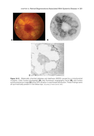 A B
C
Figure 13-11 Maternally inherited diabetes and deafness (MIDD) caused by a mitochondrial
mutation. Color fundus photo­
graph (A), late fluorescein angiography frame (B), and fundus
autofluorescence image (C) show RPE atrophy in a perifoveal distribution.­
These findings ­
were
all symmetrically pre­
sent in the fellow eye. (Courtesy of Herb Cantrill, MD.)
Chapter 13: Ret­
i­
nal Degenerations Associated With Systemic Disease ● 331
 