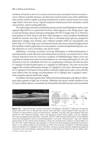 334 ● Retina and Vitreous
incidence of toxicity is low, it is a serious concern ­
because associated vision loss rarely re-
covers. Patients and their primary care physicians must be made aware of the ophthalmic
risks and the need for regular screening examinations to detect ret­
i­
nal toxicity at an early
stage, before vision loss occurs. Typical symptoms include paracentral scotomata, central
vision decline, and/or reading difficulty.
Theearliestsignsoftoxicityincludebilateralparacentralvisualfielddefectsand/orinner
segment ellipsoid loss in a paracentral location, which appears as the “flying saucer” sign
on spectral-­
domain optical coherence tomography (SD-­
OCT) images (Fig 14-1). However,
most patients of Asian descent ­
will show initial damage in a more peripheral distribution
outside the macular area (Fig 14-2). When ­
there is continued drug exposure, progressive
pigmentary changes may develop, and a bilateral atrophic bull’s-­
eye maculopathy may
ensue (Fig 14-3). End-­
stage cases of advanced toxicity may show panret­
i­
nal degeneration
that simulates retinitis pigmentosa. In some patients, corneal intraepithelial deposits, usu-
ally referred to as cornea verticillata, may also be noted.
Ophthalmic screening of patients receiving chloroquine or hydroxychloroquine is
aimed primarily at early detection and minimization of toxicity. As summarized in a 2016
Clinical Statement from the American Acad­
emy of Ophthalmology (https://www.aao
.org/clinical-statement/revised-recommendations-on-screening-chloroquine-h), the risk
of toxicity is low for individuals who have no complicating conditions and take less than
6.5 mg/kg/d of hydroxychloroquine or 3 mg/kg/d of chloroquine. The most recent data
suggest that a hydroxychloroquine dosage of 5 mg/kg/d or less and a chloroquine dosage
of 2.3 mg/kg/d or less based on the patient’s real body weight may be safer across all body
mass indexes than the dosage recommendation of 6.5 mg/kg/d and 3 mg/kg/d, respec-
tively using the patient’s ideal body weight.
Cumulative total doses greater than 1000 g of hydroxychloroquine and 460 g of chloro-
quine place patients at high risk of toxicity. Additional risk ­
factors include duration of use
(5 years), kidney disease, concomitant use of tamoxifen (fivefold increase), and concomitant
10-07-2013 SITA-Standard
27
28
30
31
29
29 32
31
30 31 32 30 30 31 32 30
30 30 28
29 31
31 28 31
31 32 31 32 31 31 29
30 31 31 33 32 28 27 27
30 29 30 31 33 29 26 27 28
28 25 28 29 26 29 29
29 28 28 28 28 29 29
29 30 29 27 26
28
5.9 mm
Fovea: 37 dB FL: 0/16 FN: 0% FP: 1%
MD: –3.24 dB P  2% PSD: 1.64 dB P  5%
Figure 14-1 Spectral-­
domain optical coherence tomography (SD-­
OCT) image and Humphrey
visual field (HVF) from a 50-­
year-­
old ­
woman who had been using Plaquenil 400 mg daily for
10 years to treat systemic lupus erythematosus. Notably, she also had lupus-­
related nephrotic
syndrome. Her Plaquenil dosage, which was based on ­
actual body weight, was 4.4 mg/kg/d.
She was completely asymptomatic. However, SD-­
OCT (left) showed attenuation of the ellipsoid
zone and interdigitation zone in a perifoveal pattern, with early “flying saucer” sign with relative
preservation of the central photoreceptors. Given the characteristic superior arcuate defect on
the 10-2 HVF (right), Plaquenil was ­
stopped. It is likely that renal disease accelerated the pre­
sen­
ta­
tion in this patient despite the dose being within the American Acad­
emy of Ophthalmology
recommendation of 5 mg/kg/d or less.Therefore, clinicians should maintain heightened vigilance
in patients with renal disease, especially when no alternatives to Plaquenil can be safely used.
(Courtesy of Amani Fawzi, MD.)
 