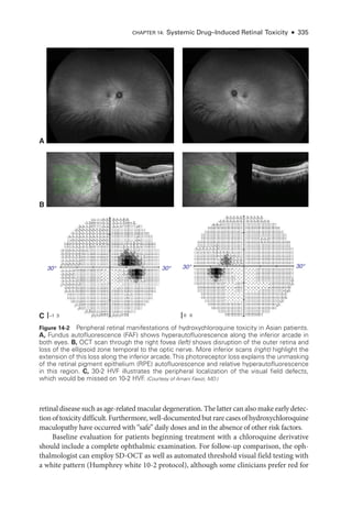 Chapter 14: Systemic Drug–­Induced Ret­i­nal Toxicity ● 335
ret­i­nal disease such as age-­related macular degeneration. The latter can also make early detec-
tionoftoxicitydifficult.Furthermore,well-­documentedbutrarecasesofhydroxychloroquine
maculopathy have occurred with “safe” daily doses and in the absence of other risk ­
factors.
Baseline evaluation for patients beginning treatment with a chloroquine derivative
should include a complete ophthalmic examination. For follow-up comparison, the oph-
thalmologist can employ SD-­
OCT as well as automated threshold visual field testing with
a white pattern (Humphrey white 10-2 protocol), although some clinicians prefer red for
A
B
C
30°
–1 3 0 0
30° 30° 30°
| |
Figure 14-2 Peripheral ret­
i­
nal manifestations of hydroxychloroquine toxicity in Asian patients.
A, Fundus autofluorescence (FAF) shows hyperautofluorescence along the inferior arcade in
both eyes. B, OCT scan through the right fovea (left) shows disruption of the outer ret­
ina and
loss of the ellipsoid zone temporal to the optic nerve. More inferior scans (right) highlight the
extension of this loss along the inferior arcade.This photoreceptor loss explains the unmasking
of the ret­
i­
nal pigment epithelium (RPE) autofluorescence and relative hyperautofluorescence
in this region. C, 30-2 HVF illustrates the peripheral localization of the visual field defects,
which would be missed on 10-2 HVF
. (Courtesy of Amani Fawzi, MD.)
 
