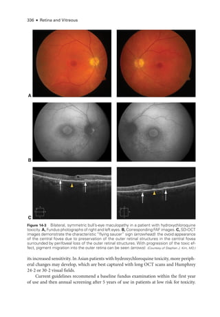 336 ● Retina and Vitreous
its increased sensitivity. In Asian patients with hydroxychloroquine toxicity, more periph-
eral changes may develop, which are best captured with long OCT scans and Humphrey
24-2 or 30-2 visual fields.
Current guidelines recommend a baseline fundus examination within the first year
of use and then annual screening ­
after 5 years of use in patients at low risk for toxicity.
A
B
C
Figure 14-3 Bilateral, symmetric bull’s-­
eye maculopathy in a patient with hydroxychloroquine
toxicity. A, Fundus photo­graphs of right and left eyes. B, Corresponding FAF images. C, SD-­OCT
images demonstrate the characteristic “flying saucer” sign (arrowhead): the ovoid appearance
of the central fovea due to preservation of the outer ret­
i­
nal structures in the central fovea
surrounded by perifoveal loss of the outer ret­
i­
nal structures. With progression of the toxic ef-
fect, pigment migration into the outer ret­
ina can be seen (arrows). (Courtesy of Stephen J. Kim, MD.)
 