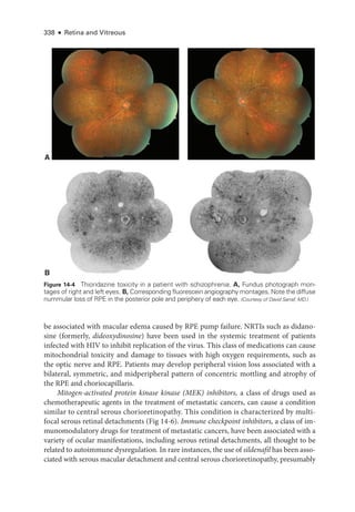 338 ● Retina and Vitreous
be associated with macular edema caused by RPE pump failure. NRTIs such as didano-
sine (formerly, dideoxydinosine) have been used in the systemic treatment of patients
infected with HIV to inhibit replication of the virus. This class of medi­
cations can cause
mitochondrial toxicity and damage to tissues with high oxygen requirements, such as
the optic nerve and RPE. Patients may develop peripheral vision loss associated with a
bilateral, symmetric, and midperipheral pattern of concentric mottling and atrophy of
the RPE and choriocapillaris.
Mitogen-­
activated protein kinase kinase (MEK) inhibitors, a class of drugs used as
chemotherapeutic agents in the treatment of metastatic cancers, can cause a condition
similar to central serous chorioretinopathy. This condition is characterized by multi-
focal serous ret­
i­
nal detachments (Fig 14-6). Immune checkpoint inhibitors, a class of im-
munomodulatory drugs for treatment of metastatic cancers, have been associated with a
variety of ocular manifestations, including serous ret­
i­
nal detachments, all thought to be
related to autoimmune dysregulation. In rare instances, the use of sildenafil has been asso-
ciated with serous macular detachment and central serous chorioretinopathy, presumably
A
B
Figure 14-4 Thioridazine toxicity in a patient with schizo­
phre­
nia. A, Fundus photo­
graph mon-
tages of right and left eyes. B, Corresponding fluorescein angiography montages. Note the diffuse
nummular loss of RPE in the posterior pole and periphery of each eye. (Courtesy of David Sarraf, MD.)
 