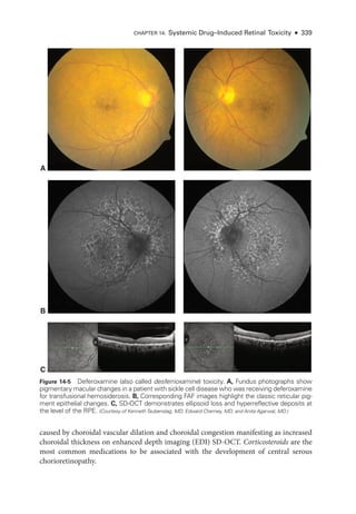 Chapter 14: Systemic Drug–­Induced Ret­i­nal Toxicity ● 339
A
B
C
Figure 14-5 Deferoxamine (also called desferrioxamine) toxicity. A, Fundus photo­
graphs show
pigmentary macular changes in a patient with sickle cell disease who was receiving deferoxamine
for transfusional hemosiderosis. B, Corresponding FAF images highlight the classic reticular pig-
ment epithelial changes. C, SD-­
OCT demonstrates ellipsoid loss and hyperreflective deposits at
the level of the RPE. (Courtesy of KennethTaubenslag, MD, Edward Cherney, MD, and Anita Agarwal, MD.)
caused by choroidal vascular dilation and choroidal congestion manifesting as increased
choroidal thickness on enhanced depth imaging (EDI) SD-­
OCT. Corticosteroids are the
most common medi­
cations to be associated with the development of central serous
chorioretinopathy.
 