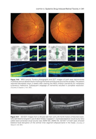 Chapter 14: Systemic Drug–­Induced Ret­i­nal Toxicity ● 341
Figure 14-6 MEK toxicity. Fundus photo­
graphs and OCT images of both eyes demonstrate
multifocal serous detachments involving the fovea and the area around the arcades.The patient
reported decreased vision 3 weeks ­
after starting the MEK inhibitor trametinib for metastatic
cutaneous melanoma. Subsequent stoppage of trametinib resulted in complete resolution.
(Courtesy of Stephen J. Kim, MD.)
Figure 14-7 SD-­
OCT images from a 40-­
year-­
old man with a 6-­
month history of blurred vision,
who admitted to long-­
term use of alkyl nitrites (“poppers”). Corrected distance visual acuity (also
called best-­
corrected visual acuity) was 20/40 OD, 20/50 OS. SD-­
OCT of both eyes showed
bilateral focal disruption of the central inner segment ellipsoid band in the fovea. (Courtesy of
Manjot K. Gill, MD.)
 