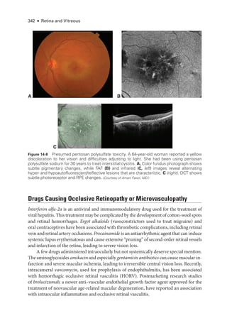 342 ● Retina and Vitreous
Drugs Causing Occlusive Retinopathy or Microvasculopathy
Interferon alfa-2a is an antiviral and immunomodulatory drug used for the treatment of
viral hepatitis. This treatment may be complicated by the development of cotton-­
wool spots
and ret­i­nal hemorrhages. Ergot alkaloids (vasoconstrictors used to treat migraine) and
oral contraceptives have been associated with thrombotic complications, including ret­i­
nal
vein and ret­i­nal artery occlusions. Procainamide is an antiarrhythmic agent that can induce
systemic lupus erythematosus and cause extensive “pruning” of second-­
order ret­
i­
nal vessels
and infarction of the ret­
ina, leading to severe vision loss.
A few drugs administered intraocularly but not systemically deserve special mention.
The aminoglycosides amikacin and especially gentamicin antibiotics can cause macular in-
farction and severe macular ischemia, leading to irreversible central vision loss. Recently,
intracameral vancomycin, used for prophylaxis of endophthalmitis, has been associated
with hemorrhagic occlusive ret­
i­
nal vasculitis (HORV). Postmarketing research studies
of brolucizumab, a newer anti–­
vascular endothelial growth ­
factor agent approved for the
treatment of neovascular age-­
related macular degeneration, have reported an association
with intraocular inflammation and occlusive ret­
i­
nal vasculitis.
A B
C
Figure 14-8 Presumed pentosan polysulfate toxicity. A 64-­
year-­
old ­
woman reported a yellow
discoloration to her vision and difficulties adjusting to light. She had been using pentosan
polysulfate sodium for 30 years to treat interstitial cystitis. A, Color fundus photo­
graph shows
subtle pigmentary changes, while FAF (B) and infrared (C, left) images reveal alternating
hyper-­and hypoautofluorescent/reflective lesions that are characteristic. C (right), OCT shows
subtle photoreceptor and RPE changes. (Courtesy of Amani Fawzi, MD.)
 