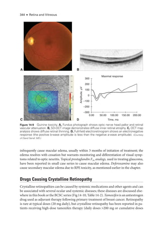 344 ● Retina and Vitreous
infrequently cause macular edema, usually within 3 months of initiation of treatment; the
edema resolves with cessation but warrants monitoring and differentiation of visual symp-
toms related to optic neuritis. Topical prostaglandin F2α analogs, used in treating glaucoma,
have been reported in small case series to cause macular edema. Deferoxamine may also
cause secondary macular edema due to RPE toxicity, as mentioned ­
earlier in the chapter.
Drugs Causing Crystalline Retinopathy
Crystalline retinopathies can be caused by systemic medi­
cations and other agents and can
be associated with several ocular and systemic diseases; ­
these diseases are discussed else-
where in this book or the BCSC series (Fig 14-10, ­Table 14-2). Tamoxifen is an antiestrogen
drug used as adjuvant therapy following primary treatment of breast cancer. Retinopathy
is rare at typical doses (20 mg daily), but crystalline retinopathy has been reported in pa-
tients receiving high-­
dose tamoxifen therapy (daily doses 200 mg or cumulative doses
A B
C D
Maximal response
Time, ms
Amplitude,
μV
0.00 50.00 100.00 150.00 200.00
300
200
100
0
–100
–200
–300
Figure 14-9 Quinine toxicity. A, Fundus photo­
graph shows optic nerve head pallor and ret­
i­
nal
vascular attenuation. B, SD-­
OCT image demonstrates diffuse inner ret­
i­
nal atrophy. C, OCT map
analy­
sis shows diffuse ret­
i­
nal thinning. D, Full-­
field electroretinogram shows an electronegative
response (the positive b-­
wave amplitude is less than the negative a-­
wave amplitude). (Courtesy
of David Sarraf, MD.)
 