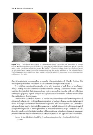 346 ● Retina and Vitreous
show telangiectasia, masquerading as macular telangiectasia type 2 (MacTel 2); thus, this
maculopathy should be considered in the differential diagnosis of MacTel 2.
A crystalline maculopathy may also occur ­
after ingestion of high doses of canthaxan-
thine, a widely available carotenoid used to simulate tanning. In the inner ret­
ina, cantha­
xanthine deposits distribute in a doughnut pattern around the macula, with a predilection
for the juxtapapillary region. They do not typically cause vision loss and may resolve ­
after
the medi­
cation is discontinued.
Intravascular crystalline deposits of oxalate have been observed ­
after the ingestion of
ethylene glycol and ­
after prolonged administration of methoxyflurane anesthesia (an agent
that is no longer used in the United States) in patients with renal dysfunction. Other ret­
i­
nal crystals that may be deposited intravascularly include talc emboli, which are injected
along with drugs such as methylphenidate in persons who inject drugs. The refractile talc
deposits usually embolize in the smaller-­caliber perifoveal ret­i­nal arterioles and may cause
peripheral ret­
i­
nal neovascularization in rare cases; they do not typically cause vision loss.
Drenser K, Sarraf D, Jain A, Small KW. Crystalline retinopathies. Surv Ophthalmol. 2006;51(6):
535–549.
A
B
Figure 14-11 Crystalline retinopathy in a ­
woman receiving tamoxifen for treatment of breast
cancer. A, Fundus photo­
graphs show punctate pigmentary changes. Rare inner ret­
i­
nal crystals
­
were noted on slit-­
lamp biomicroscopy. B, SD-­
OCT of the right eye shows subtle but charac-
teristic inner layer foveal cystic changes with central disruption and loss of the ellipsoid band;
the left eye demonstrates inner layer foveal cystic changes only. (Courtesy of KennethTaubenslag, MD,
and Stephen J. Kim, MD.)
 